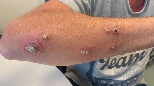 EFFECTIVE LEISHMANIASIS CONTROL: TOP EPIDEMIOLOGY TRENDS AND STRATEGIES