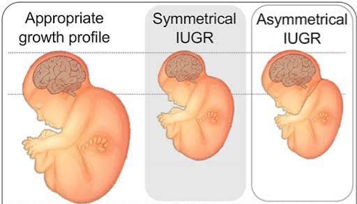EXPLORING THE CAUSES AND EFFECTS OF INTRAUTERINE GROWTH RESTRICTION EXPLORING THE CAUSES AND EFFECTS OF INTRAUTERINE GROWTH RESTRICTION