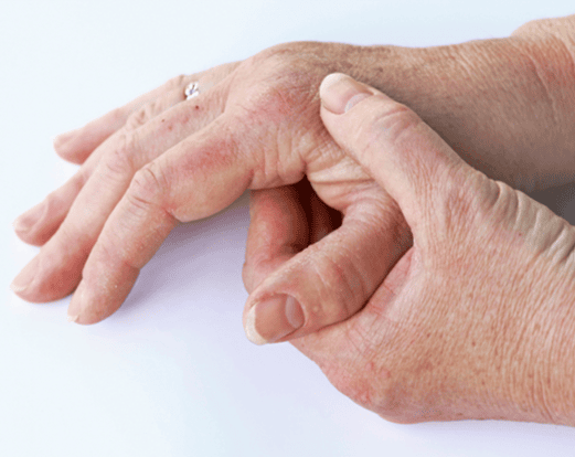 TREATMENT OPTIONS FOR CONNECTIVE TISSUE DISEASES EXPLAINED TREATMENT OPTIONS FOR CONNECTIVE TISSUE DISEASES EXPLAINED