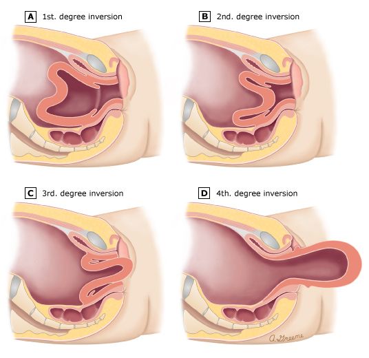 IMMEDIATE RESPONSE TO UTERINE INVERSION: ESSENTIAL EMERGENCY PROCEDURES