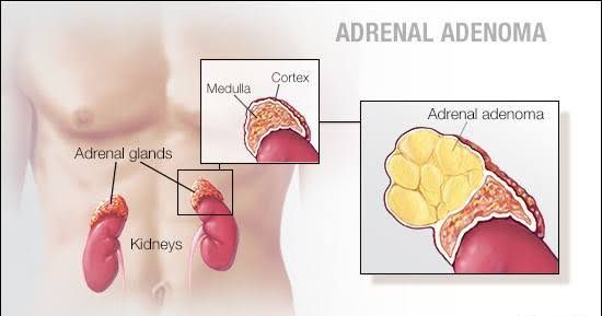 PATHOLOGY OF THE ADRENAL GLANDS