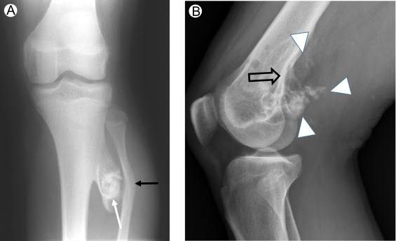 IMAGING TECHNIQUES OF X-RAY IN BONE TUMORS