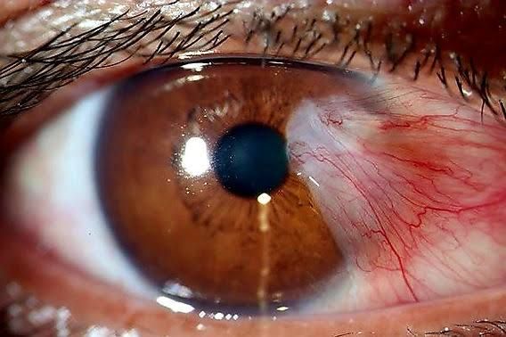 CAUSES AND SYMPTOMS OF PTERYGIUM EXPLAINED