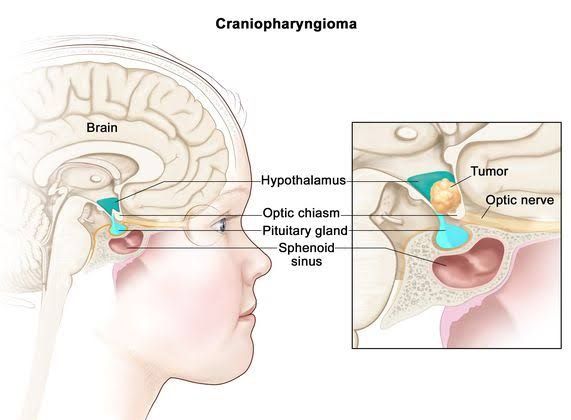 PATHOLOGY OF THE ANTERIOR AND POSTERIOR PITUITARY GLAND PATHOLOGY OF THE ANTERIOR AND POSTERIOR PITUITARY GLAND