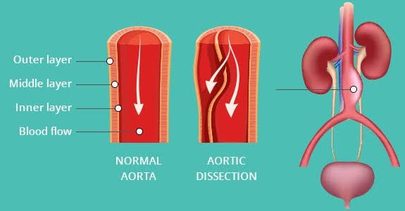 WHAT YOU NEED TO KNOW ABOUT AORTIC DISEASES