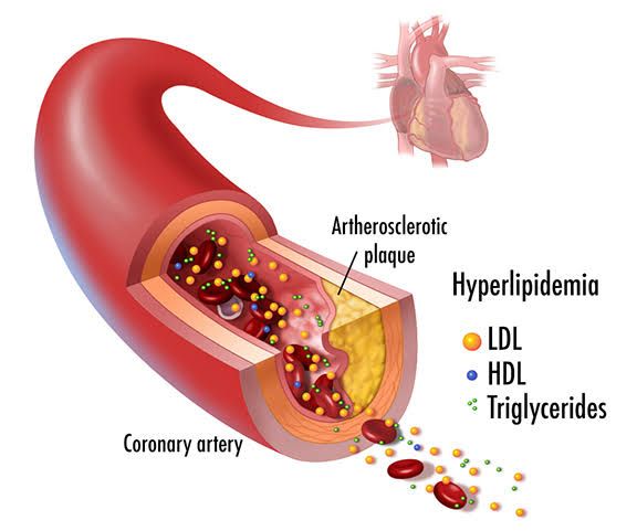MANAGING HYPERLIPIDEMIAS: ESSENTIAL TIPS FOR HEALTH MANAGING HYPERLIPIDEMIAS: ESSENTIAL TIPS FOR HEALTH
