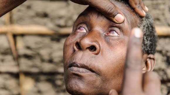 LEARN WHAT TRACHOMA IS AND HOW IT AFFECTS VISION