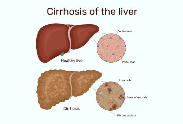 HOW LIVER CIRRHOSIS AFFECTS YOUR HEALTH HOW LIVER CIRRHOSIS AFFECTS YOUR HEALTH