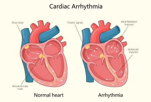 CARDIAC ARRHYTHMIA: FACTS EVERY PATIENT SHOULD KNOW CARDIAC ARRHYTHMIA: FACTS EVERY PATIENT SHOULD KNOW