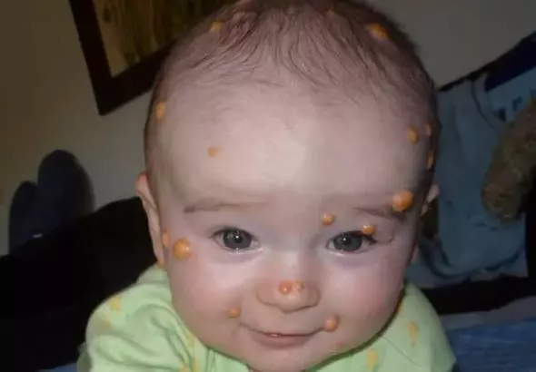 CLINICAL PERSPECTIVE ON JUVENILE XANTHOGRANULOMA: COMPREHENSIVE OVERVIEW