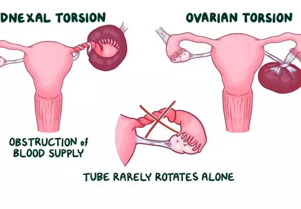THE ULTIMATE GUIDE TO MANAGING ADNEXAL TORSION: FROM SYMPTOMS TO SURGICAL SOLUTIONS