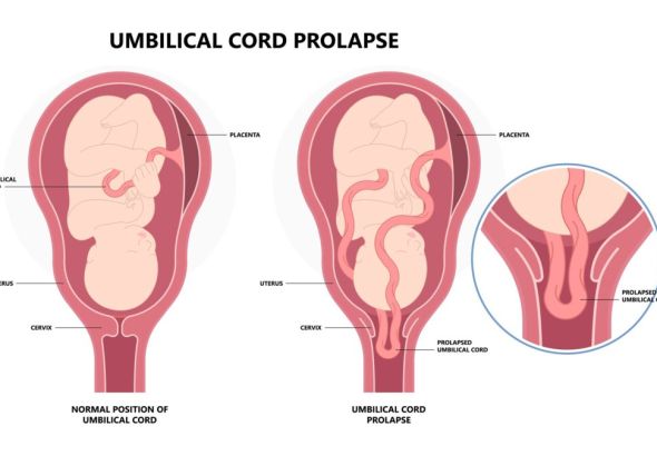 UMBILICAL CORD PROLAPSE: AN IN-DEPTH OBSTETRIC ANALYSIS
