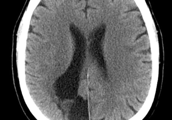 INTRODUCTION TO PORENCEPHALY: EVERYTHING YOU NEED TO KNOW