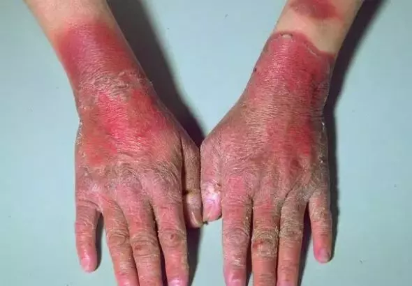 ALL YOU NEED TO KNOW ABOUT HARTNUP DISEASE