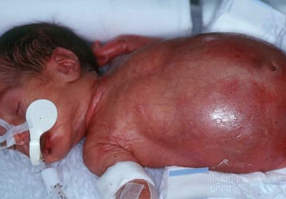 NECROTIZING ENTEROCOLITIS: INSIGHTS INTO ETIOLOGY, DIAGNOSIS TECHNIQUES, AND TREATMENT OPTIONS