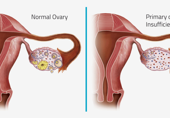 PRIMARY OVARIAN INSUFFICIENCY EXPLAINED: SYMPTOMS, CAUSES, AND TREATMENT