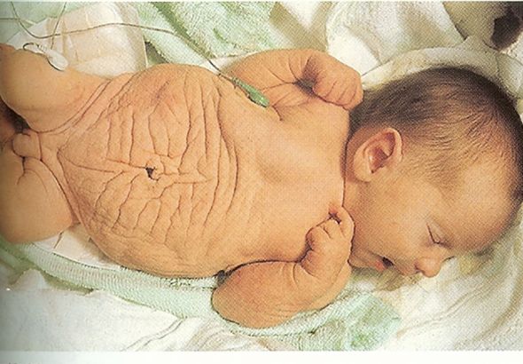 UNDERSTANDING AND TREATING PRUNE-BELLY SYNDROME