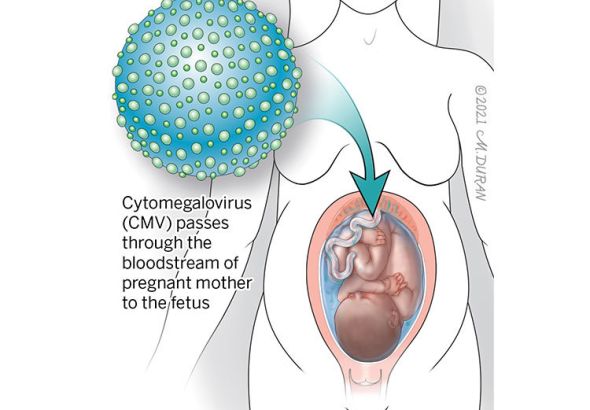 EXPERT INSIGHTS ON CONGENITAL AND PERINATAL CYTOMEGALOVIRUS INFECTION