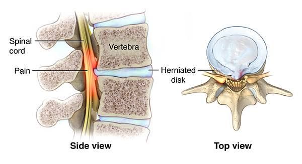 STRATEGIES FOR COPING WITH TRAUMATIC MYELOPATHIES