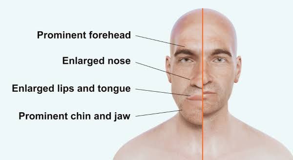 THE ROLE OF OCTREOTIDE IN MANAGING GIGANTISM: AN IN-DEPTH ANALYSIS