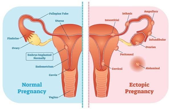 UNDERSTANDING ECTOPIC PREGNANCY: KEY FACTS YOU NEED