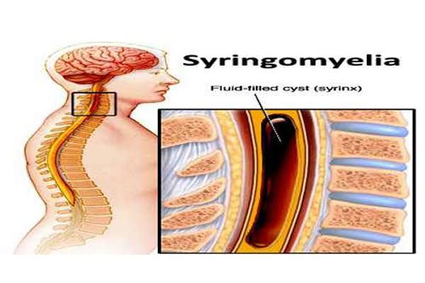 SYRINGOMYELIA: FROM ONSET TO DIAGNOSIS AND MANAGEMENT SOLUTIONS
