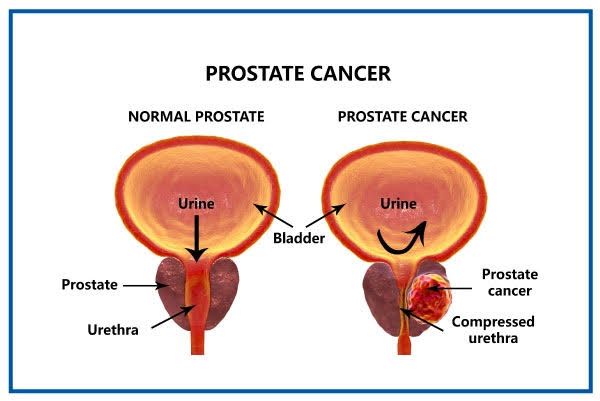 HOW HORMONAL AGENTS ARE REVOLUTIONIZING PROSTATIC CARCINOMA CARE