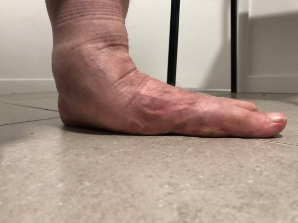 A very flat left foot.