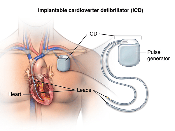 PROFESSIONAL INSIGHTS INTO PACEMAKER AND ICD THERAPY: FUNCTION, MANAGEMENT, AND BEST PRACTICES