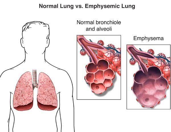 TREATMENTS FOR EMPHYSEMA AND LUNG ABSCESSES REVEALED
