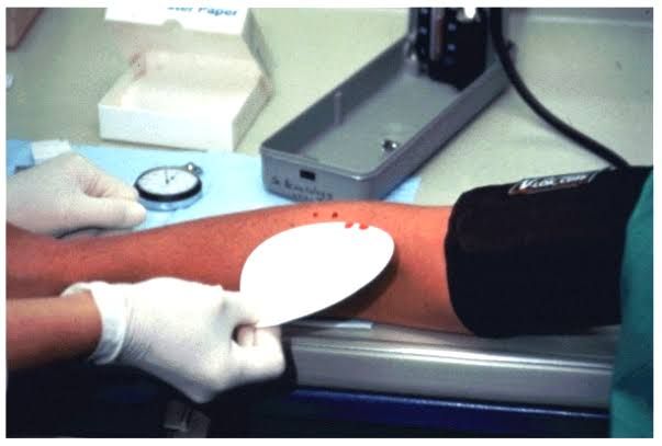HOW TO ACCURATELY MEASURE BLEEDING AND CLOTTING TIME FOR MEDICAL DIAGNOSTICS