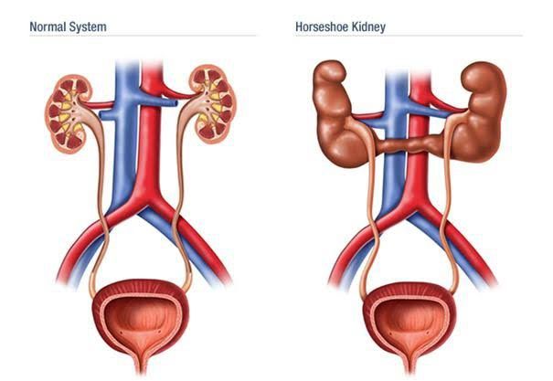 CONGENITAL AND CYSTIC DISEASES OF THE KIDNEY