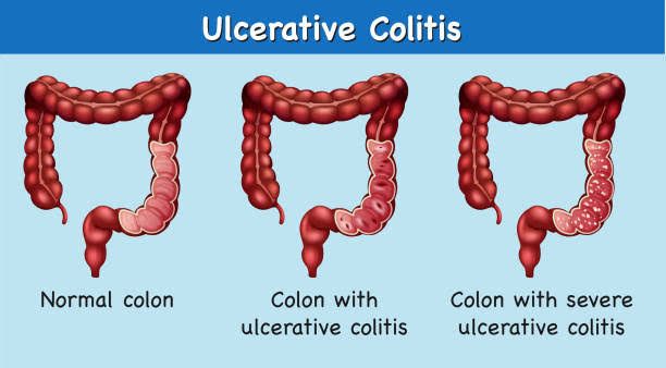 INFLAMMATORY BOWEL DISEASE TYPES AND TREATMENTS INFLAMMATORY BOWEL DISEASE TYPES AND TREATMENTS