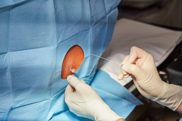 EFFECTIVE STRATEGIES FOR PREVENTING SPINAL-INDUCED HYPOTENSION DURING CAESAREAN DELIVERIES