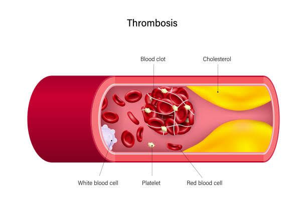 WHAT ARE HYPERCOAGULABLE DISORDERS AND HOW DO THEY AFFECT YOU WHAT ARE HYPERCOAGULABLE DISORDERS AND HOW DO THEY AFFECT YOU