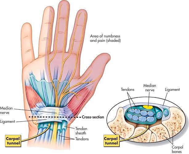PERIPHERAL NERVE INJURY: IDENTIFYING TYPES AND DEVELOPING A MANAGEMENT PLAN