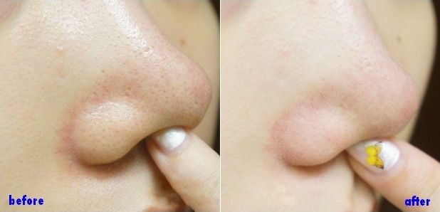 before-after