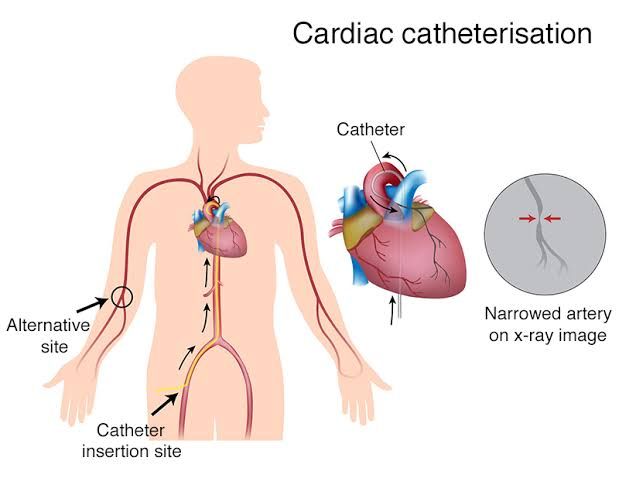 ELECTROPHYSIOLOGY TESTING AND CARDIAC CATHETERIZATION: AN IN-DEPTH ASSESSMENT