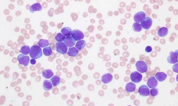 ACUTE LYMPHOBLASTIC LEUKEMIA: PATHOGENESIS, SYMPTOMS, AND DIAGNOSTIC TECHNIQUES