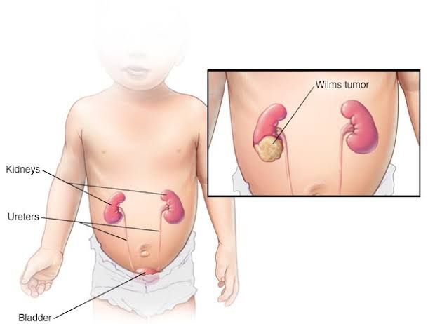 WILMS’ TUMOR: INTEGRATING GENETIC INSIGHTS WITH CLINICOPATHOLOGICAL FEATURES FOR BETTER PROGNOSIS