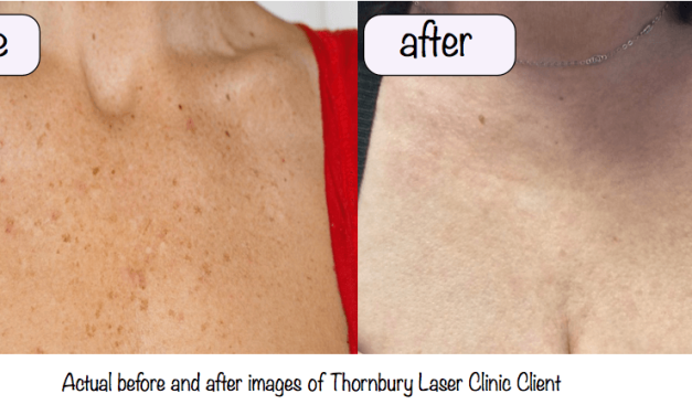 Skin rejuvenation treatments –Thornbury Laser Clinic Makeover
