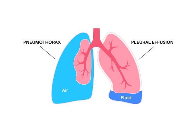 THE CONNECTION BETWEEN PLEURAL EFFUSION AND PNEUMOTHORAX: KEY INSIGHTS FOR BETTER MANAGEMENT