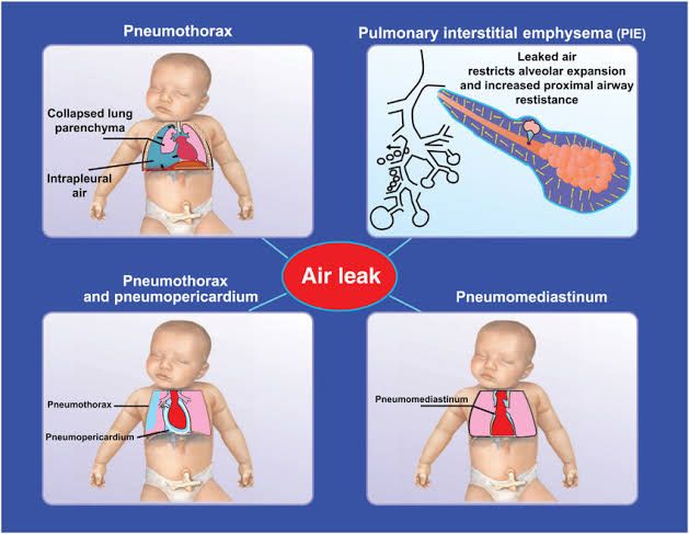 EXPLORING THE CLINICAL PRESENTATION AND MANAGEMENT OF PEDIATRIC PULMONARY AIR-LEAK SYNDROMES