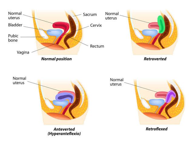 RETROVERTED FLEXION OF THE UTERUS RETROVERTED FLEXION OF THE UTERUS