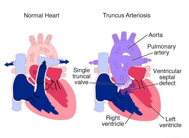 PERSISTENT TRUNCUS ARTERIOSUS EXPLAINED: DIAGNOSIS, TREATMENT, AND ...