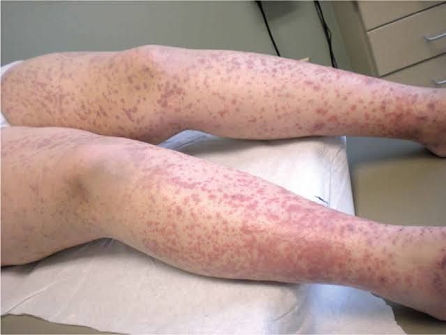 CONGENITAL BLEEDING DISORDERS AND DISSEMINATED INTRAVASCULAR COAGULATION