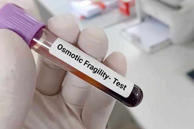 THE BASICS OF OSMOTIC FRAGILITY TESTING FOR RED BLOOD CELLS