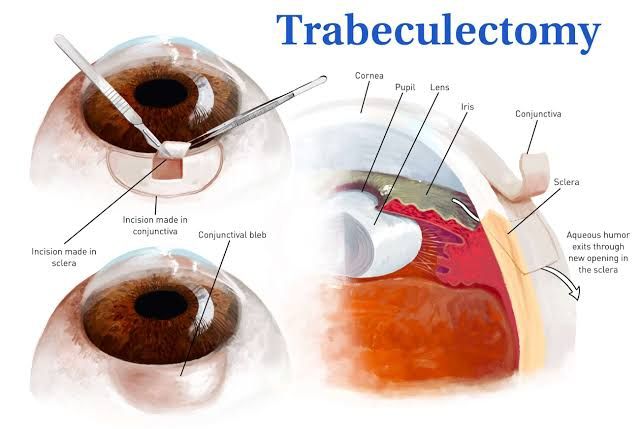 OBSERVING GLAUCOMA FILTRATION SURGERY: EDUCATIONAL GUIDE TO TRABECULECTOMY