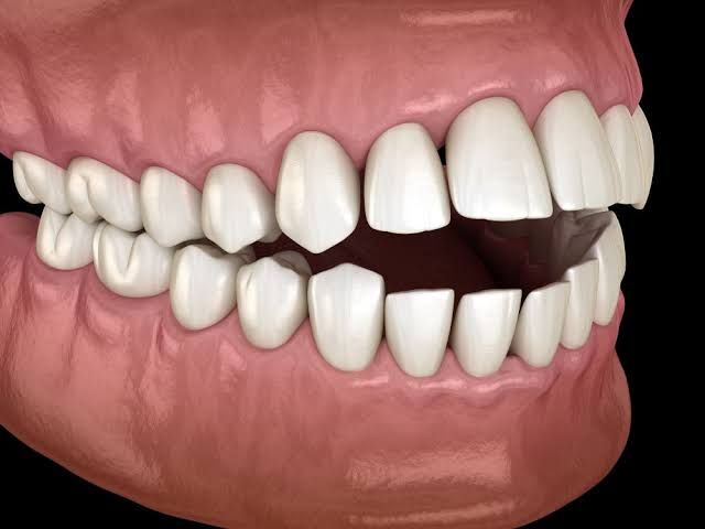 MALOCCLUSION: A GUIDE TO BETTER DENTAL HEALTH MALOCCLUSION: A GUIDE TO BETTER DENTAL HEALTH