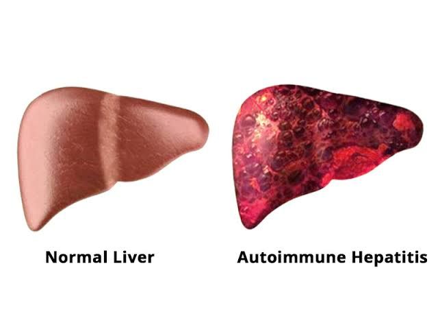 AUTOIMMUNE HEPATITIS: SYMPTOMS, DIAGNOSIS AND TREATMENT AUTOIMMUNE HEPATITIS: SYMPTOMS, DIAGNOSIS AND TREATMENT